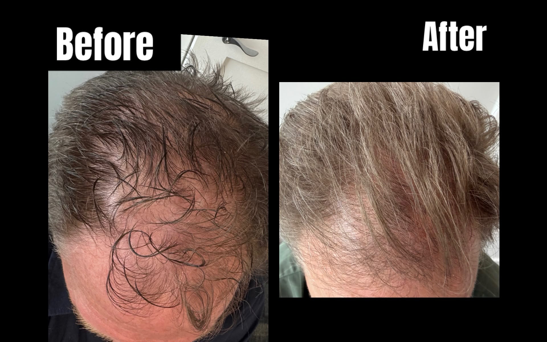 Before - Hair Restoration