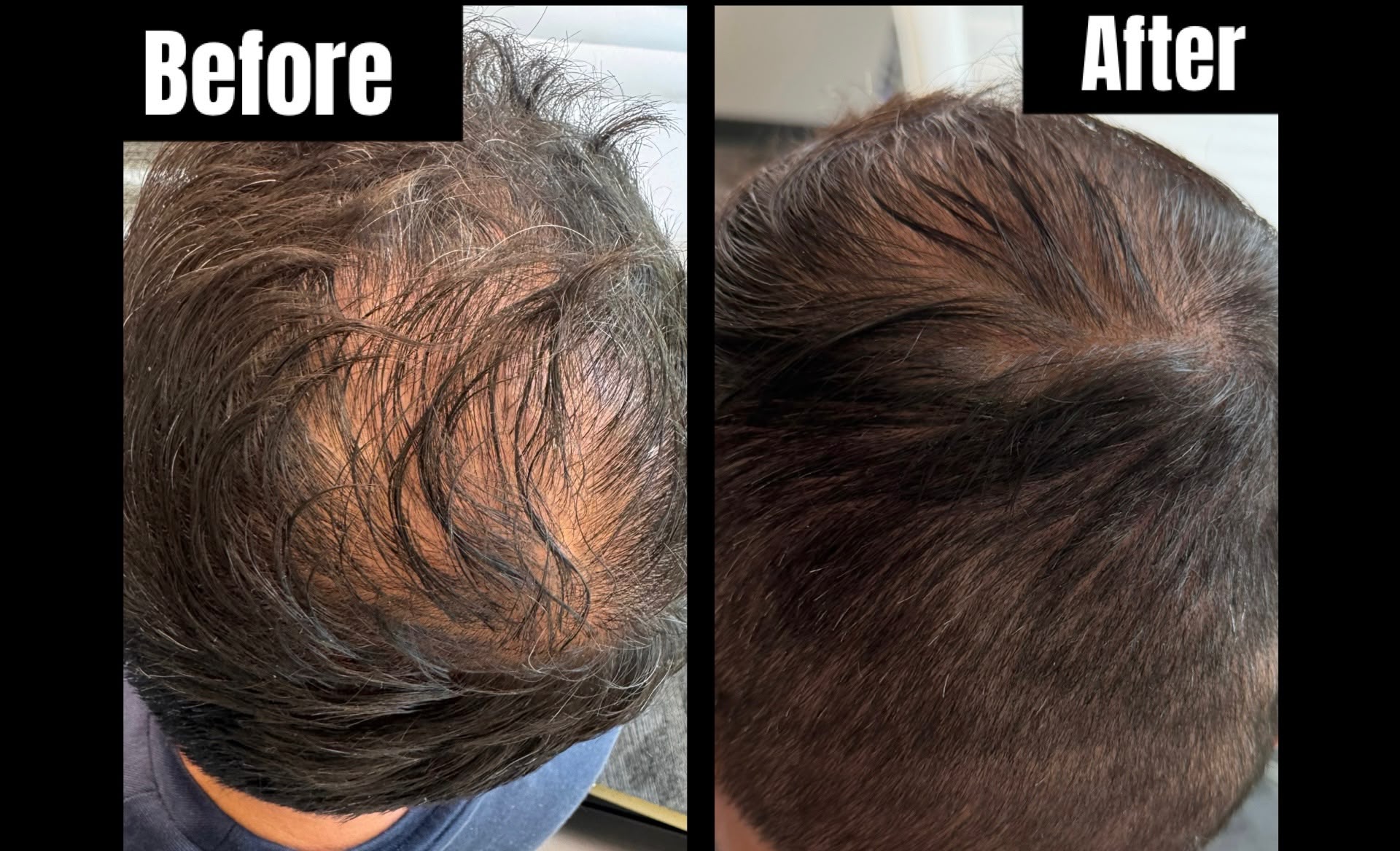 After - Hair Restoration