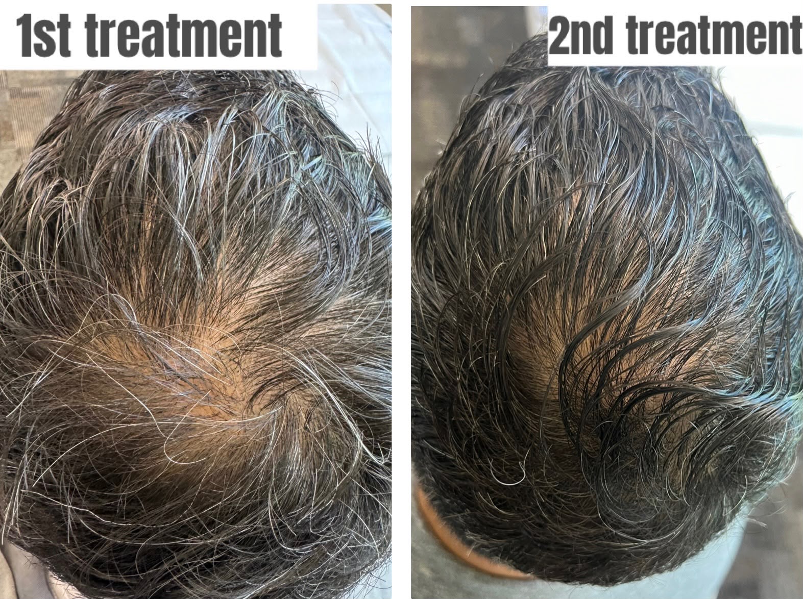 Before and After Regenerative Exosome Therapy - Patient 3 - Amiré Aesthetics New York