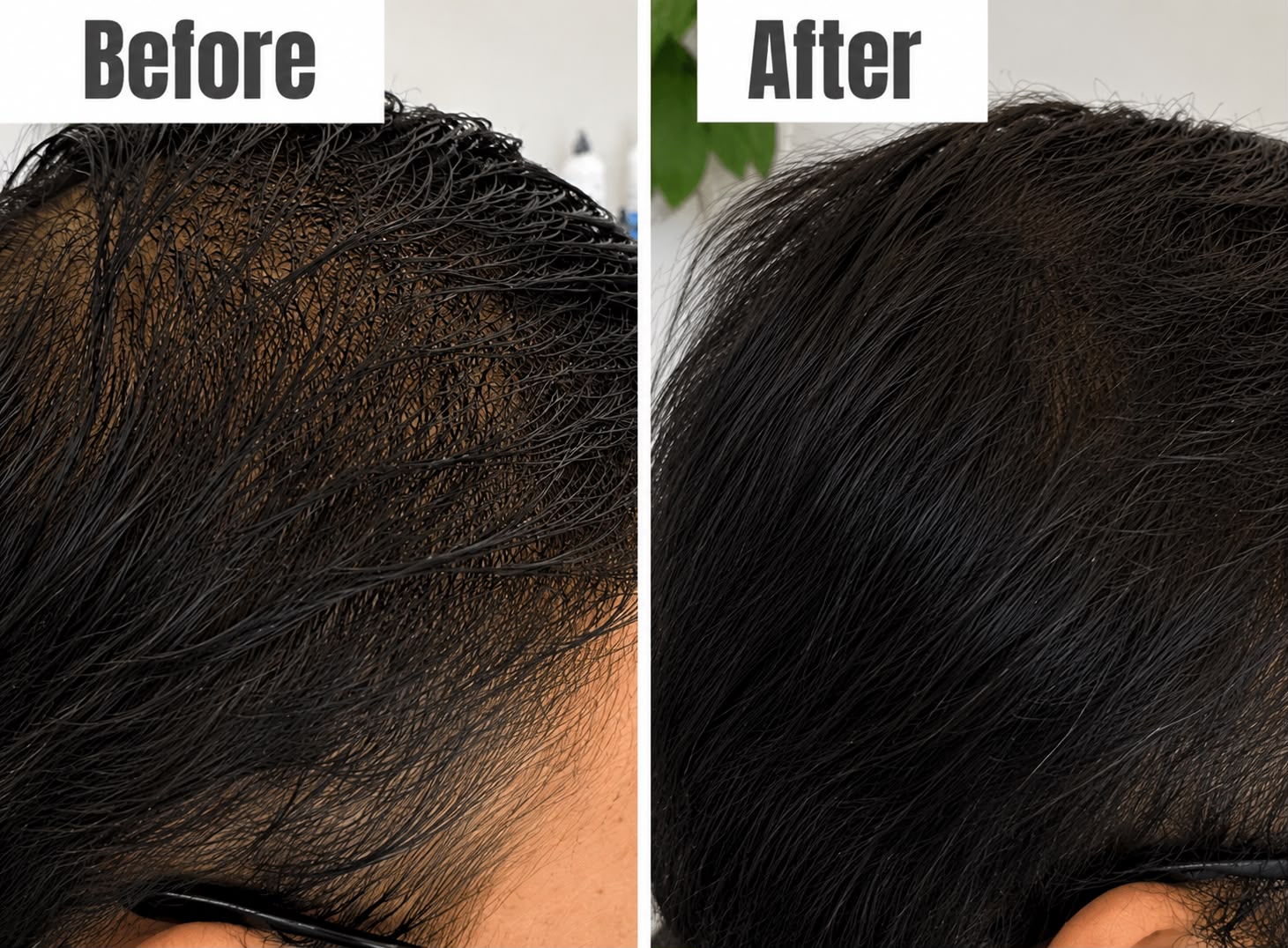 Before and After Hair Loss Therapy - Patient 4 - Amiré Aesthetics New York